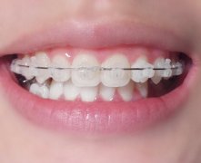 澳门牙科医院补牙价格表：3M树脂补牙200+瓷化树脂充填100+
